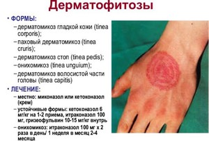 ישנם מספר סוגים של דרמטומיקוזיס.