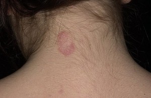 דרמטומיקוזיס על הצוואר יכולה להתבטא כנקודה קטנה