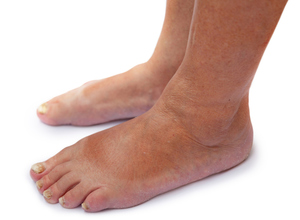 דרמטומיקוזיס של כף הרגל - סימנים חיצוניים של המחלה