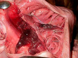 טיפול בהלמינתיאזיס בכבד יש לטפל בהלמינתיאזיס של הכבד בשלבים המוקדמים