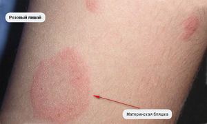 סוגי חזזיות