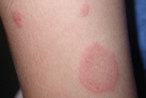 אילו סוגי חזזיות קיימים?