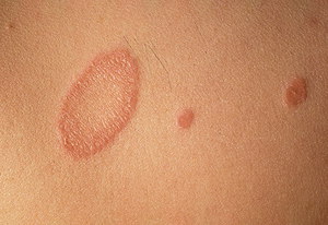 סוגי חזזיות