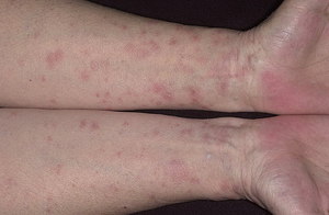 חזזית ורודה בבני אדם