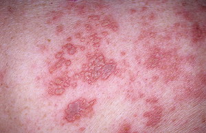 טיפול בחזזית