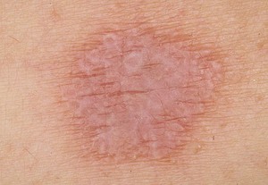 כיצד חזזית מתבטאת על העור?