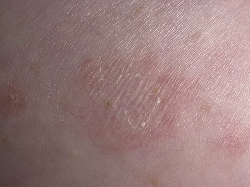 אילו סוגי חזזיות קיימים?