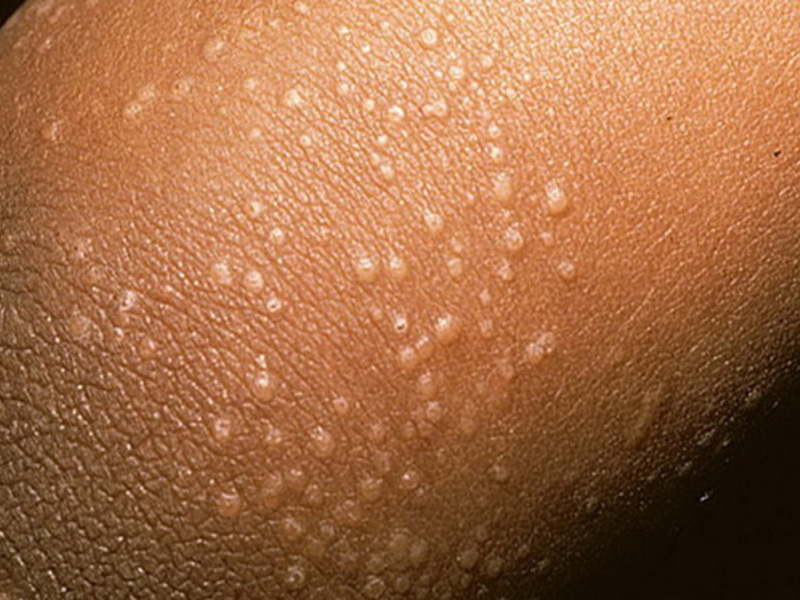 חזזית ורסיקולור