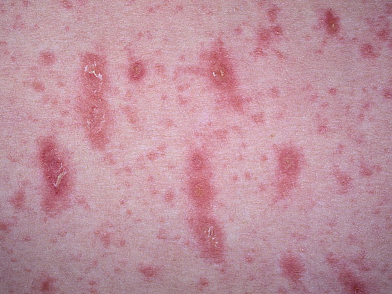 תסמינים של חזזית