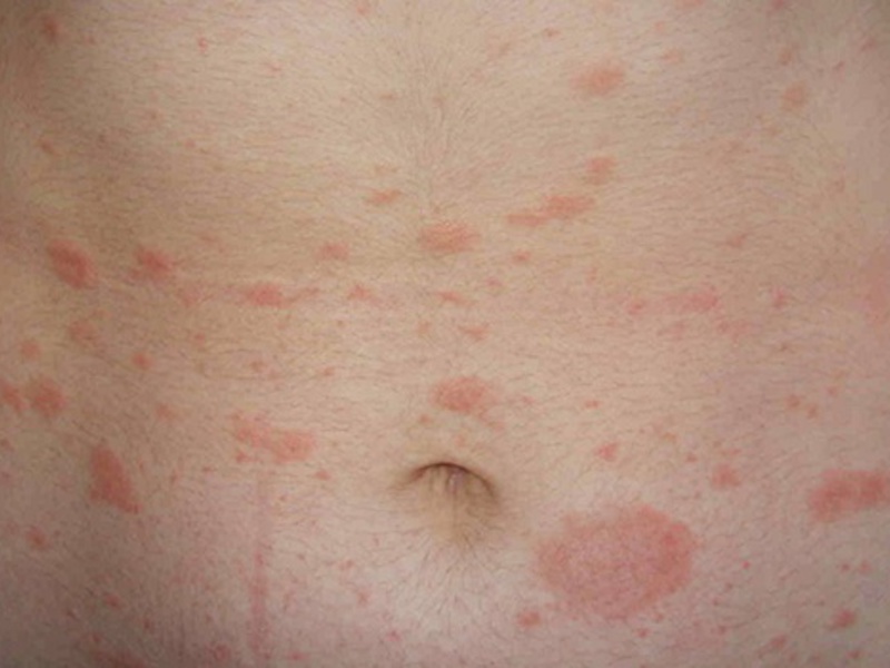 תרופות עממיות לטיפול בחזזית