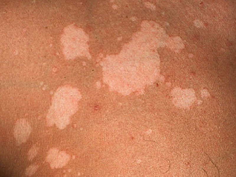 חזזית ורסיקולור