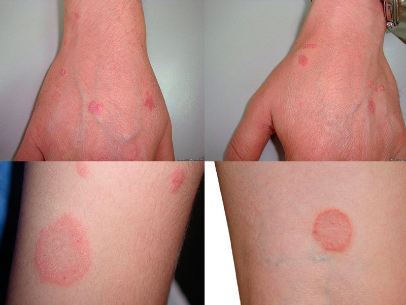 כיצד לטפל בגזזת על הגוף