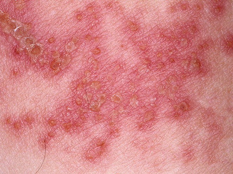 אילו סוגי חזזיות קיימים?