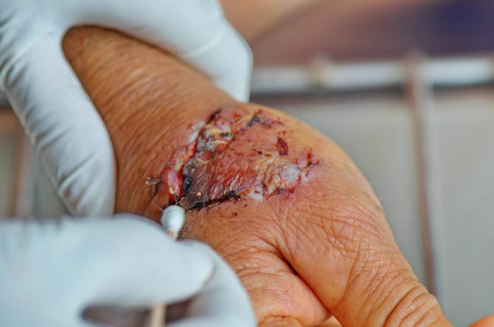 זיהום בפצע נשיכת כלב