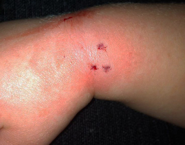 עקיצת חולדה