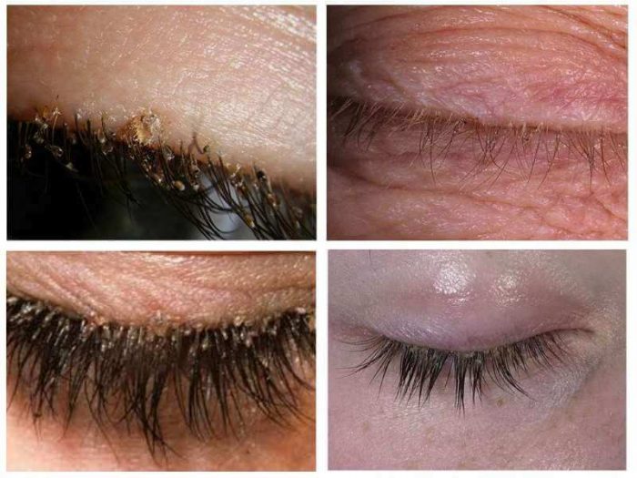 סרטנים (כיני ערווה) על ריסים