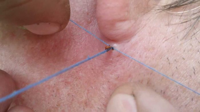 הקרציה מוסרת בעזרת חוט