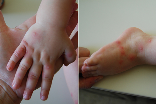 יד ורגל של ילד עם עקיצות נמלים