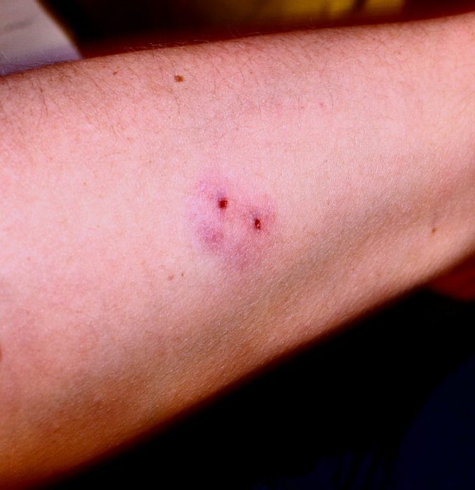 נשיכת נחש על היד