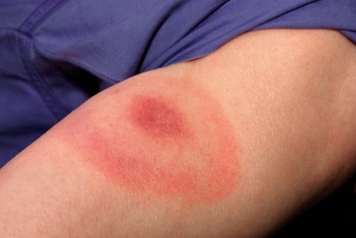 איך נראית עקיצת קרציה?