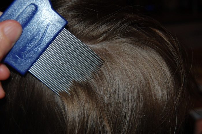 שיערו של ילד מסורק במסרק כינים ממתכת.