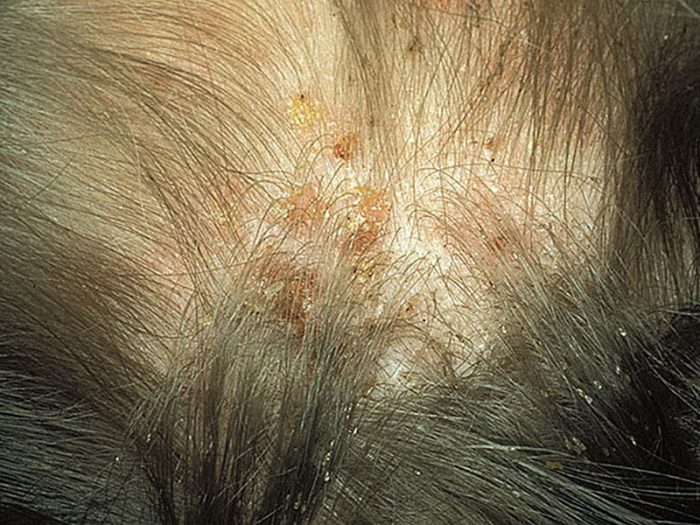 כתמים על העור וביצים על השיער