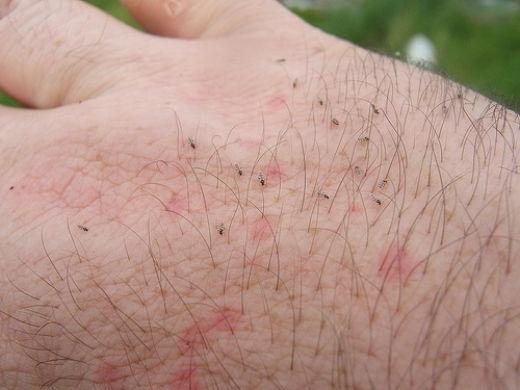 יתושים יושבים לי על היד