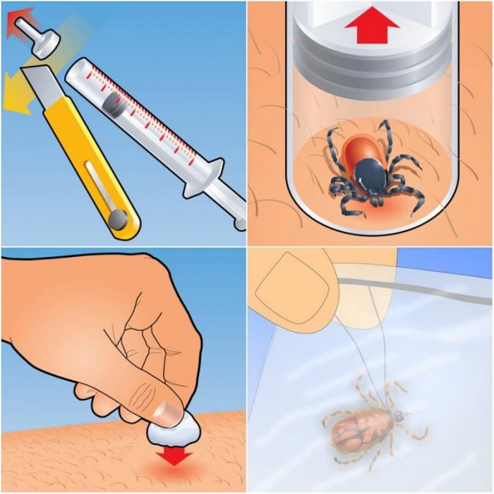 שיטה להסרת קרציה בעזרת מזרק