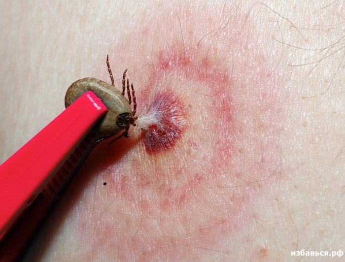 הסרת קרציה בעזרת פינצטה