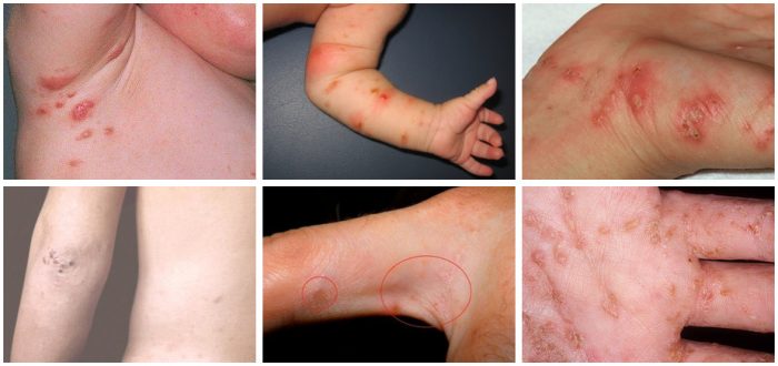 תסמינים של גרדת