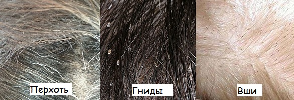 כינים, ביצים וקשקשים