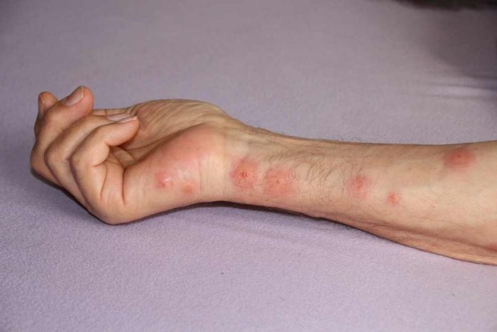 עקיצות כינים על הגוף