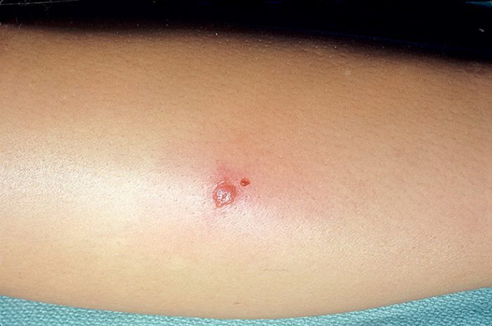 סימן נשיכת עכביש על היד