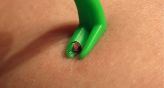 הסרת קרציה בעזרת מסיר קרציות