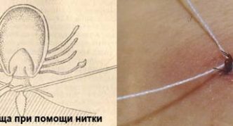 הסרת קרציה בעזרת חוט