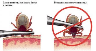 הסרת קרציה בעזרת פינצטה