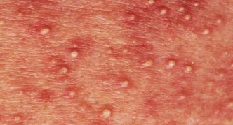 מורסות פתוחות על העור