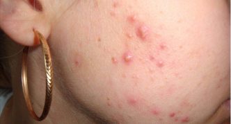 מורסות סגורות על עור הפנים