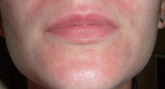 פריחה על הפנים