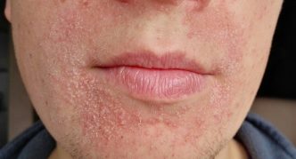 קילוף בחלק התחתון של הפנים