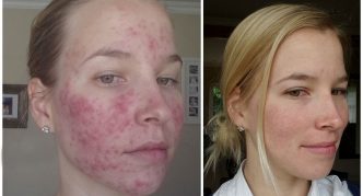 תמונות של ילדה עם ובלי דמודיקוזיס