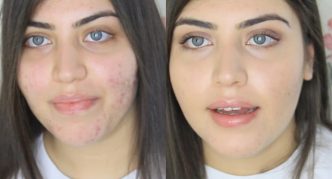 פניה של ילדה עם דמודיקוזיס ואחרי הטיפול בה