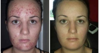 דמודקוזיס: לפני ואחרי טיפול