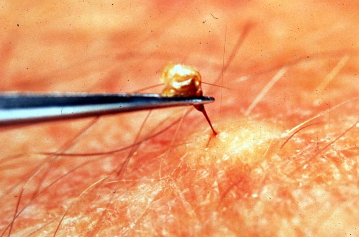 הסרת עקיצת דבורה