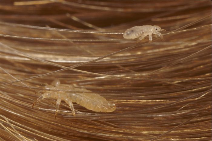 כינים בשיער