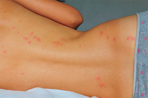 עקיצות פשפשים על גבה של ילדה