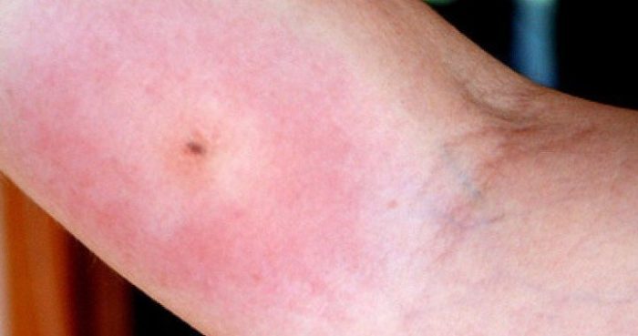 אדמומיות קשה של האמה מעקיצת פשפש