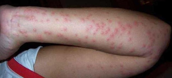 סימני נשיכה של פשפש על עור היד