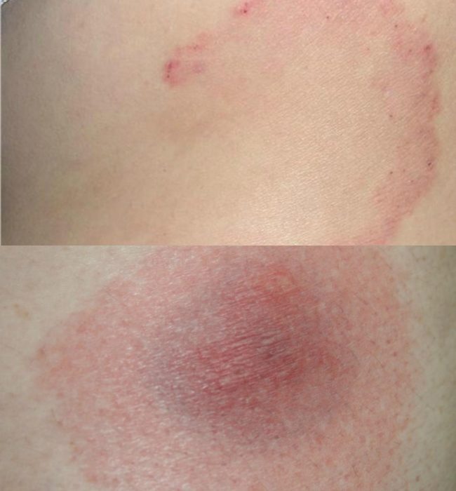 עקיצת קרציה