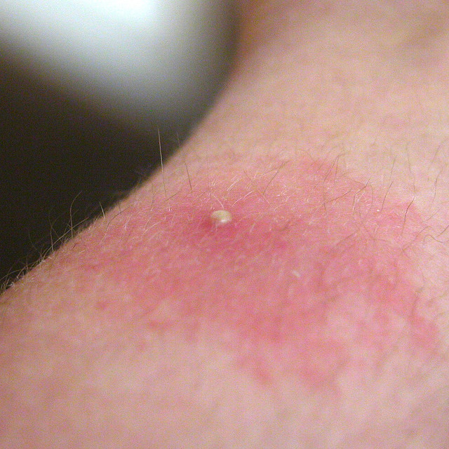 תגובה לעקיצת נמלה על עור אנושי